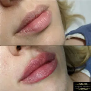 before & after lip fillers