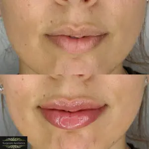 before & after lip augmentation