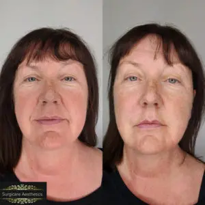 Nasolabial Line Treatment Before and After