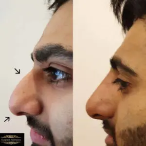 nose filler treatment