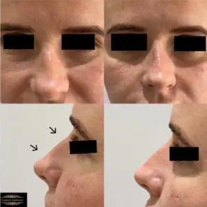 non-surgical rhinoplasty treatment