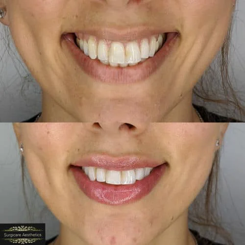 Before and After: Smile Transformation with White Teeth & Fuller Lips