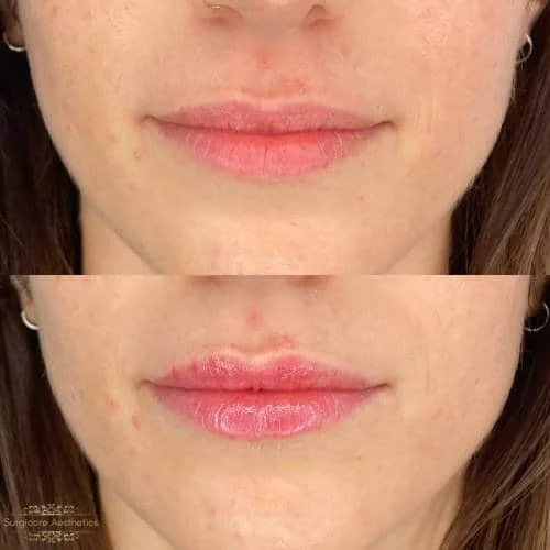 Before/After Lip Filler Transformation at Surrogate Aesthetics: Fuller Lips, Softened Wrinkles, Rejuvenated Look.