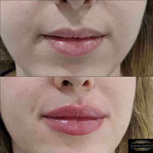 Lip Fillers Before & After: Fuller Volume, Defined Lips