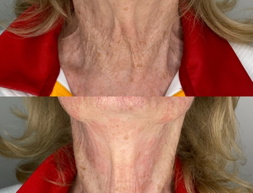 Neck & Platysmal Bands Real Transformations