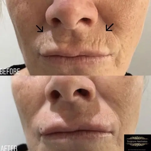 Peri-Oral LINE FILLER Real Transformations