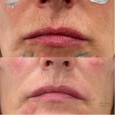 Peri-Oral Line Filler before and after
