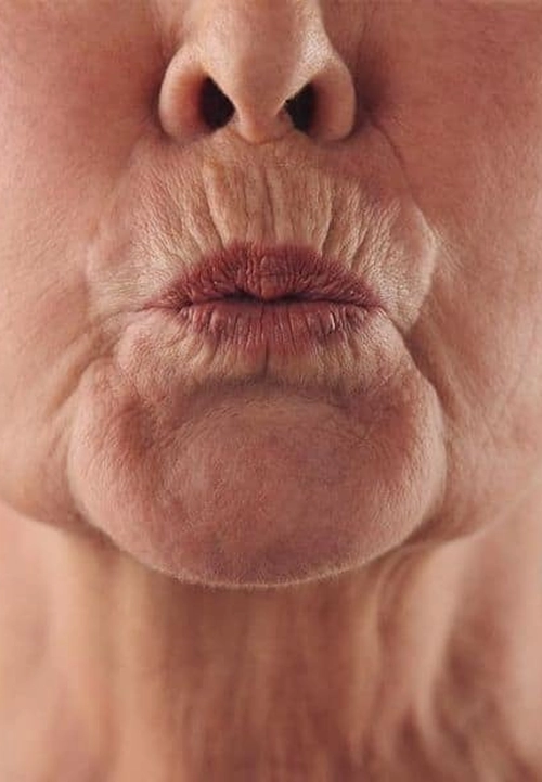 Peri-Oral Lines-Softening the ‘Barcode’ Around the Lips