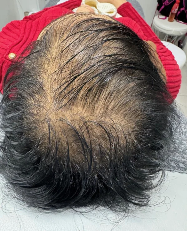 PRP for Hair Restoration Before Treatment