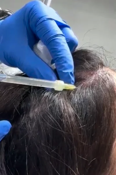 PRP for Hair Restoration PRP for Hair Restoration